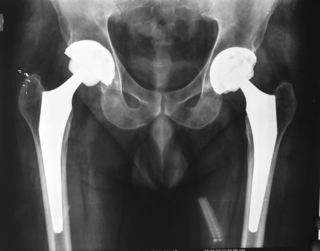 Total hip 2 UDAI OMNI HOSPITAL