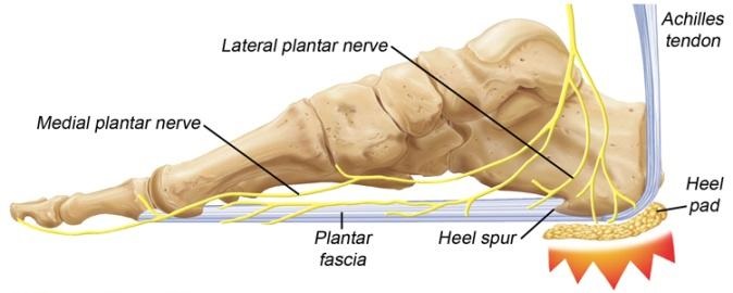 heel pad pain