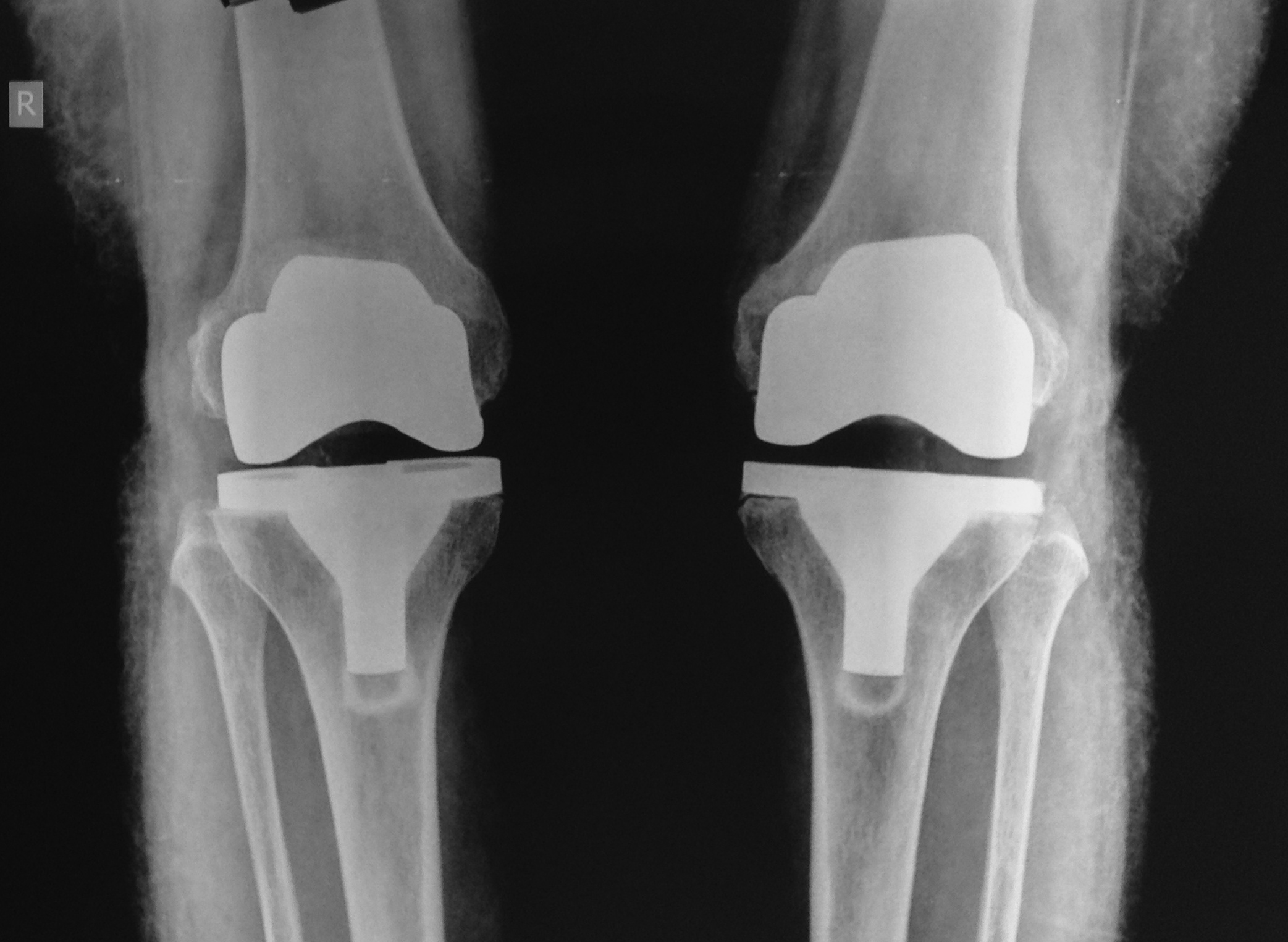 Joint Replacement Surgery Primary Or Revision Hip Knee Udai Omni