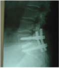 Spine Surgery in hyderabad