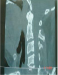 Spine Surgery in Hyderabad