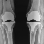 total knee replacement testimonial