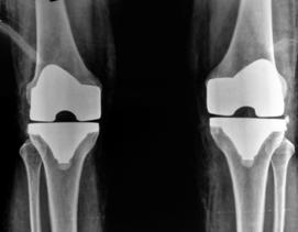 Total Knee Replacement surgery in Hyderabad