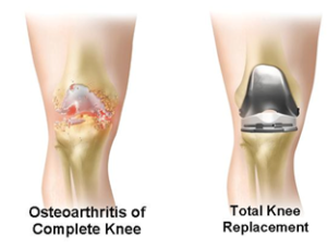 Total Knee Replacement 