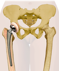 Total Hip Replacement surgery