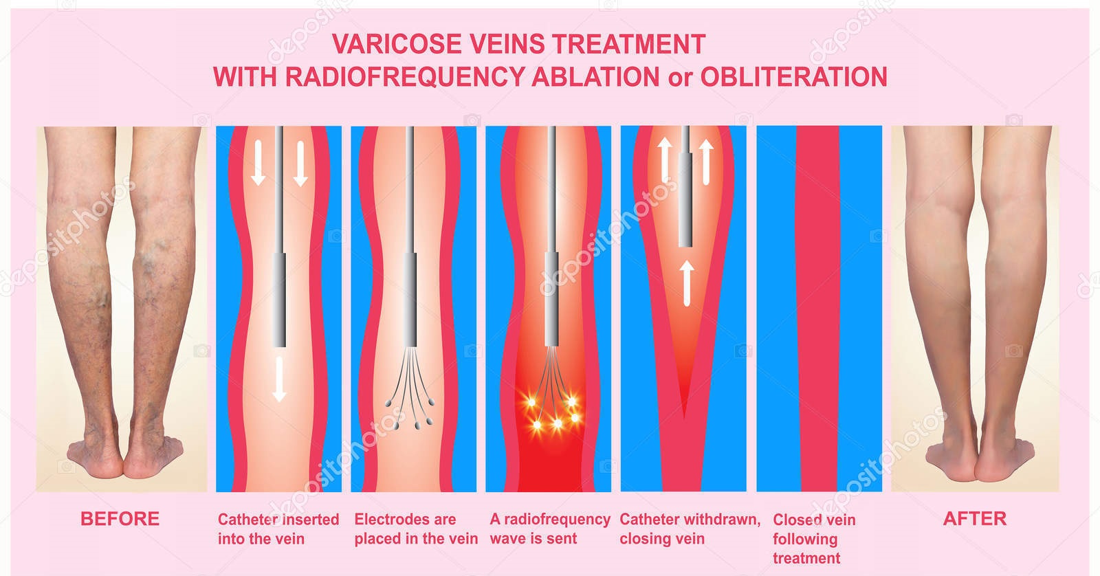 Varicose Veins And Treatment With Radiofrequency Ablation Udai Omni Hospital
