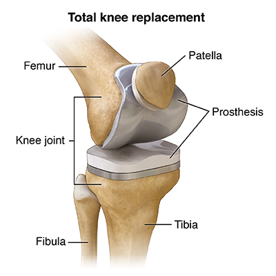 Total Knee Replacement surgery