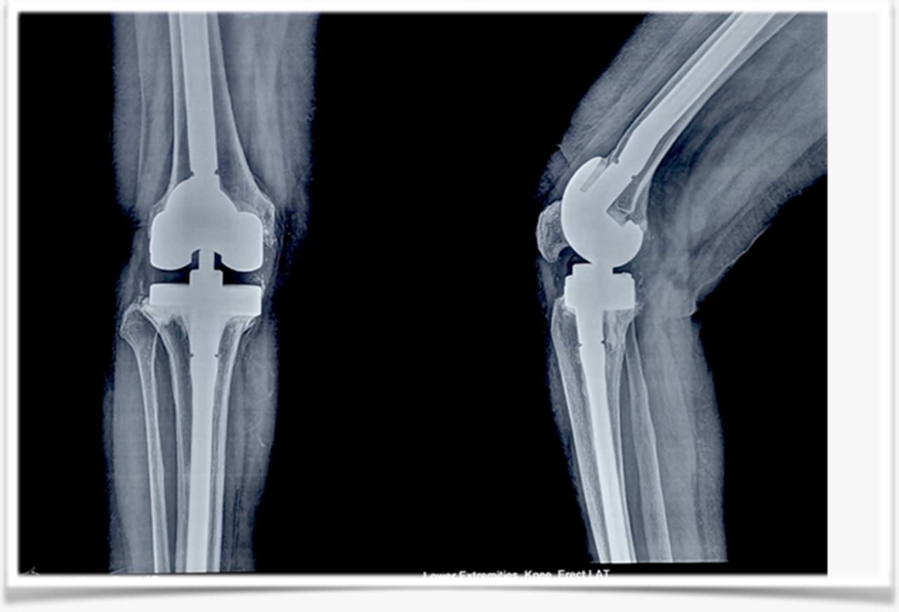 Revision Knee Replacement Surgery - UDAI OMNI HOSPITAL